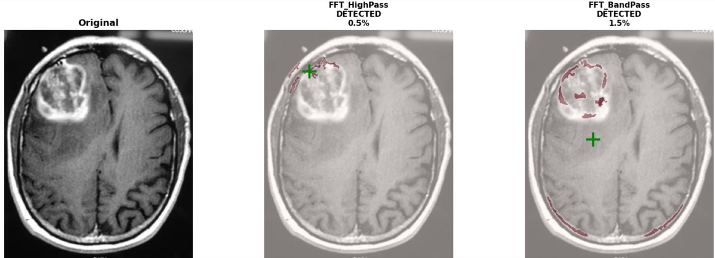 MRI slice: original beside FFT high-pass and band-pass reconstructions, with detected tumor boundary in red and the predicted centre marked by a green cross