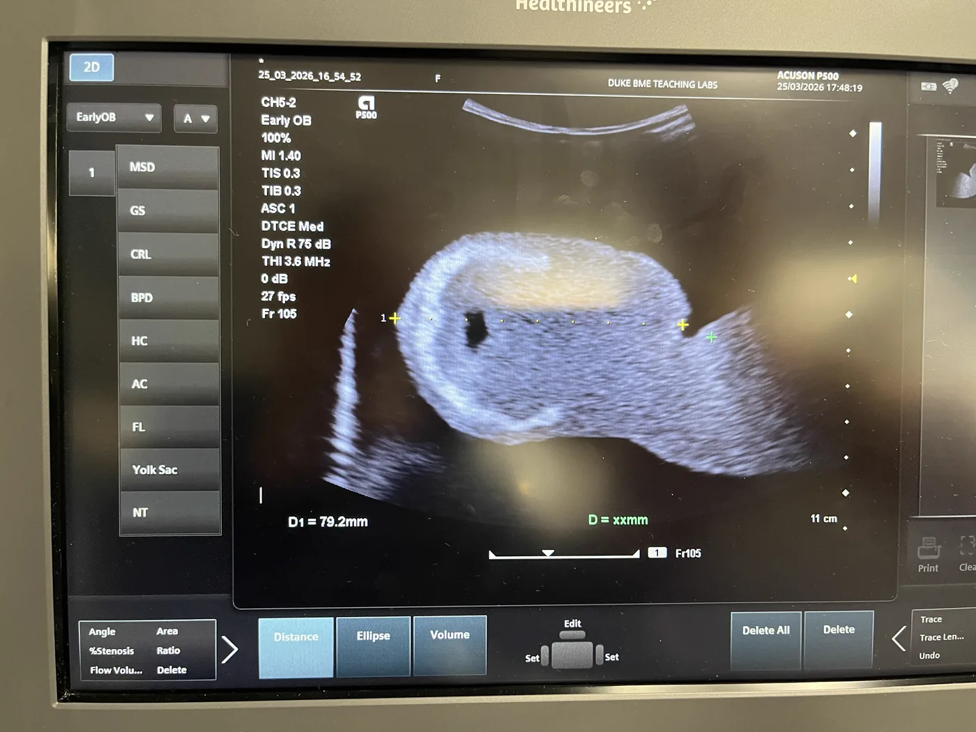An ACUSON P500 ultrasound screen at Duke BME Teaching Labs showing a B-mode image of a training phantom on the Early OB preset, with acquisition parameters listed down the left edge and a distance measurement reading D1 = 79.2 mm.